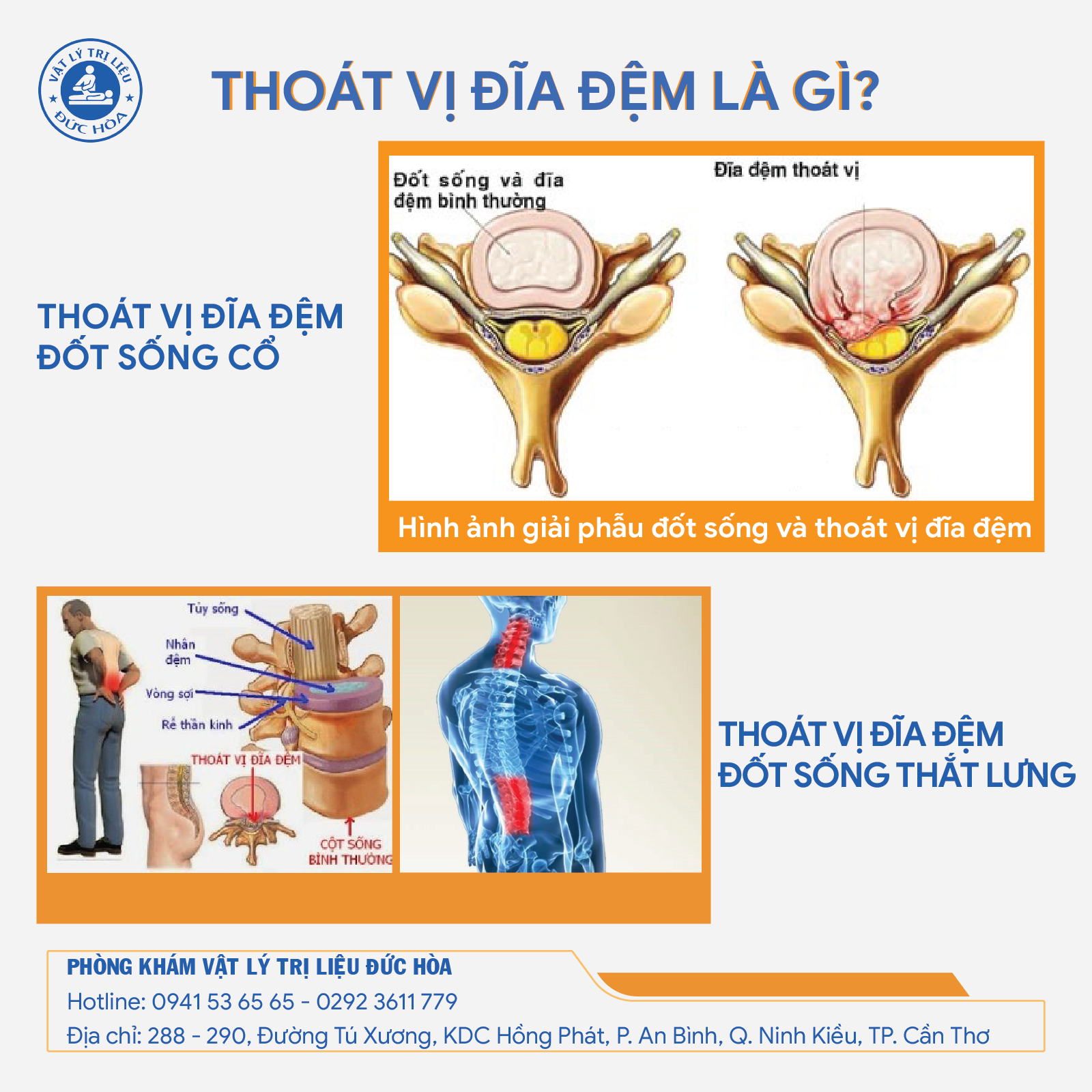 Phòng khám Đức Hòa chuyên điều trị thoát vị đĩa đệm đốt sống cổ và thoát vị đĩa đệm đốt sống thắt lưng